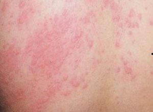 湿疹可以吃八棱瓜吗吗,湿疹患者可适量食用八棱瓜