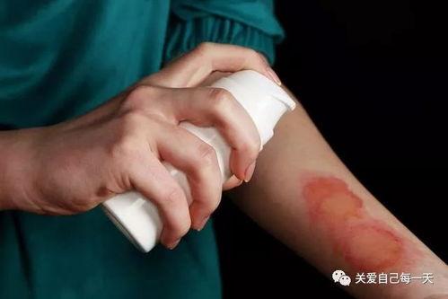 烫伤后可以吃洋瓜吗,洋瓜可否食用？